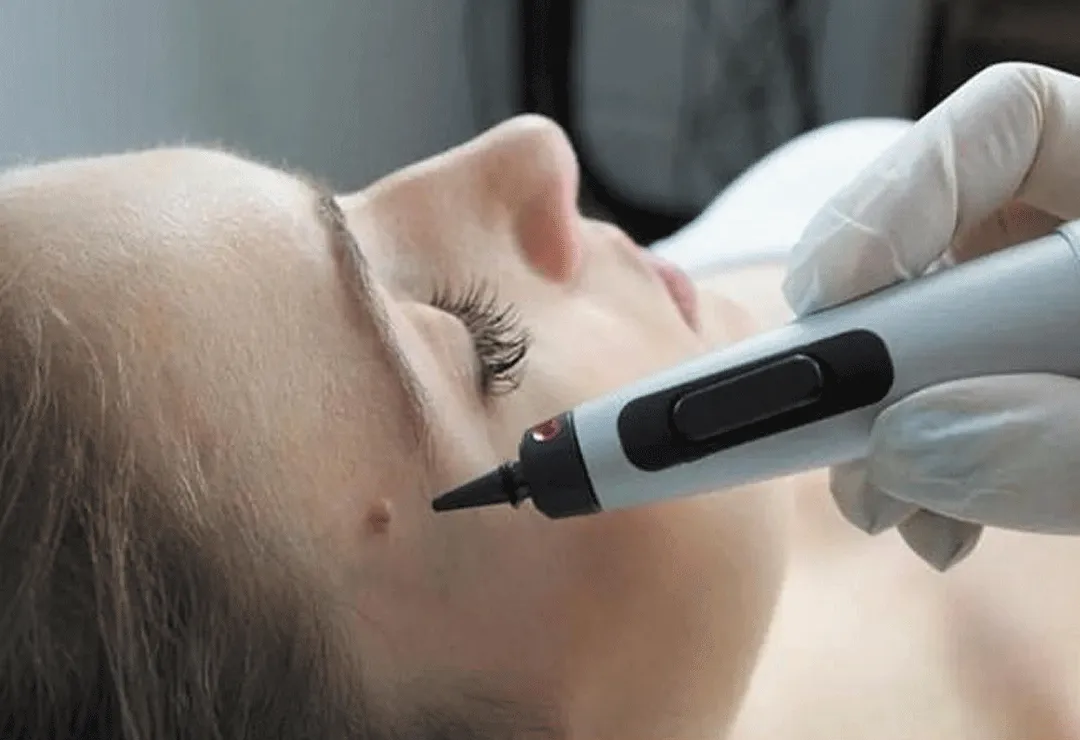 CryoPen accurately targeting skin lesions with millimetre-precision for safe and effective removal by Cryosonic Basildon