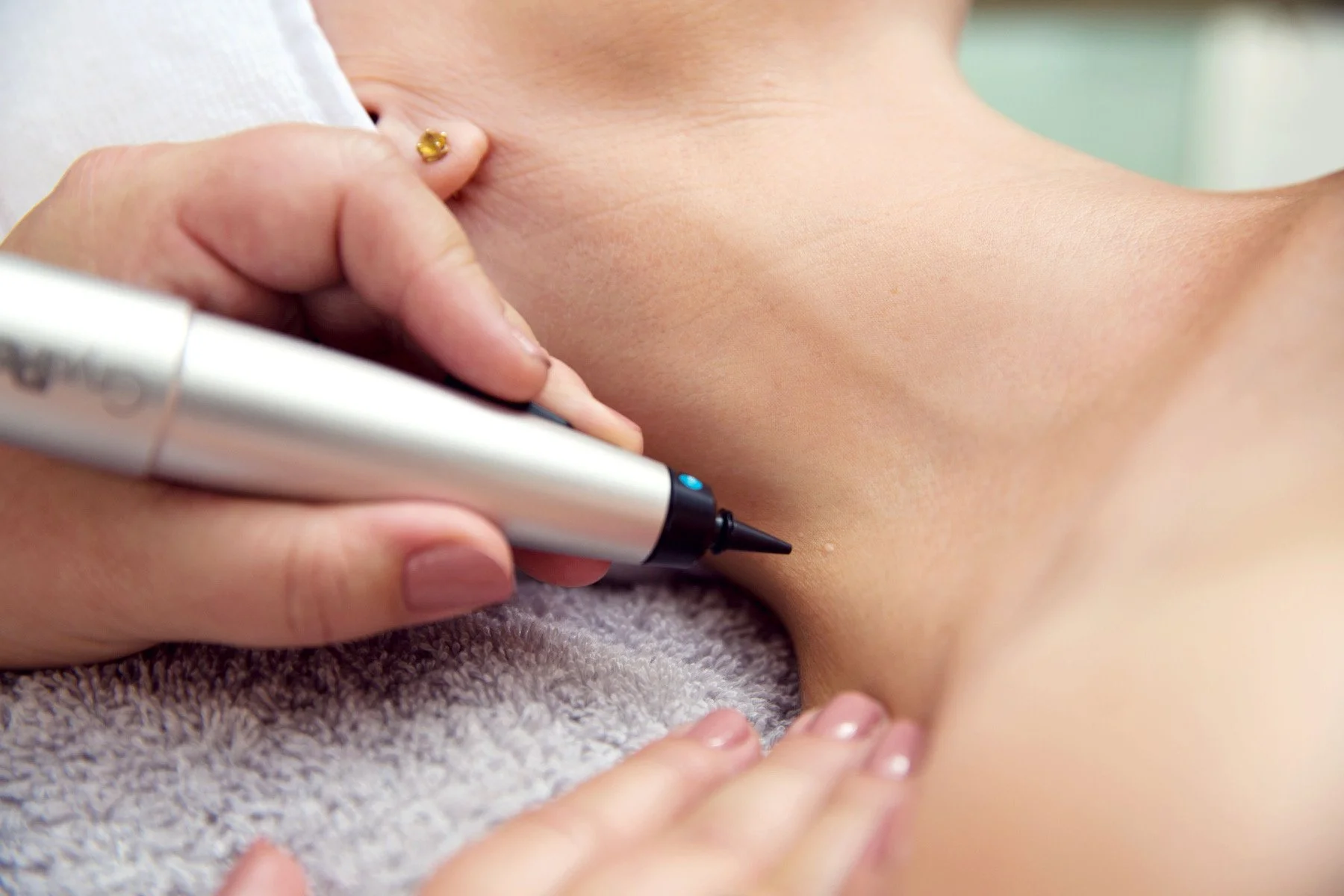 CryoPen Basildon precisely treating Molluscum Contagiosum lesions, showing safe and effective removal for faster healing by Cryosonic Basildon