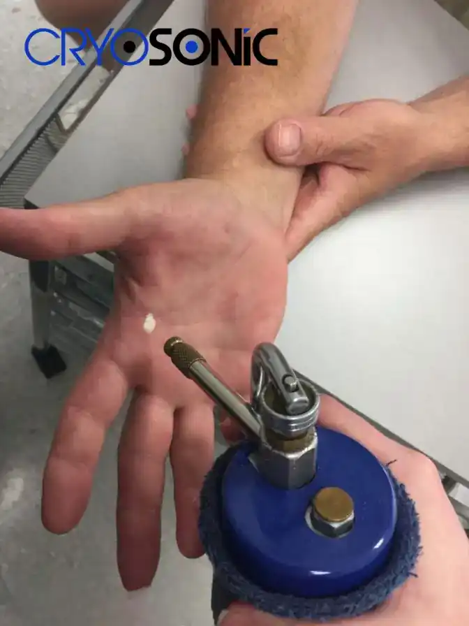 Temperature Differences: OTC vs Medical-Grade Cryotherapy Basildon
